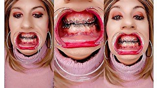 Braces fetish! See Alexandra Braces with an open mouth expander