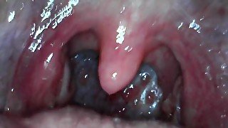 Braced girl's uvula endoscope