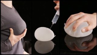 Gradual filling of expander breast implant with saline into twice its prescribed size