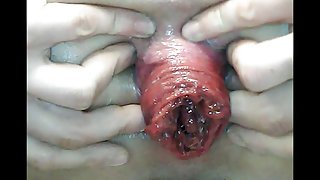 Prolapse close up 1