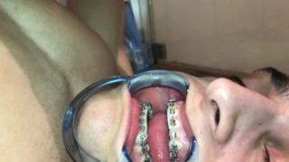 Cuming on my own braces