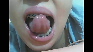 Mouth fetish braces