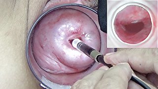 A endoscope japanese camera is inserted in the cervix to watch inside the uterus.