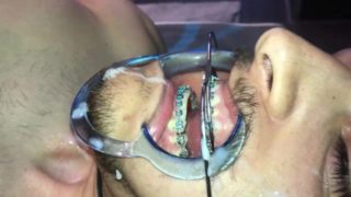 Cuming on Headgear braces