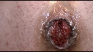 HUGE ANAL PROLAPSE PUMPING 20M