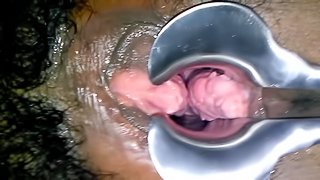 Pink Black Pussy Speculum - Ebony Speculum HD Porn Search - Xvidzz.com