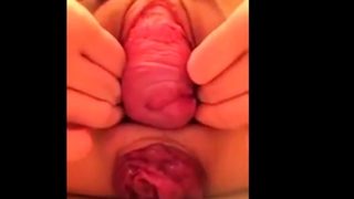 Pussy Prolapse