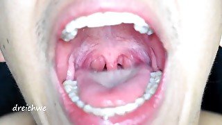 large uvula