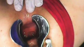 Extreme asshole Gape with Speculum