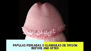 Tayson's glands or pearly papules